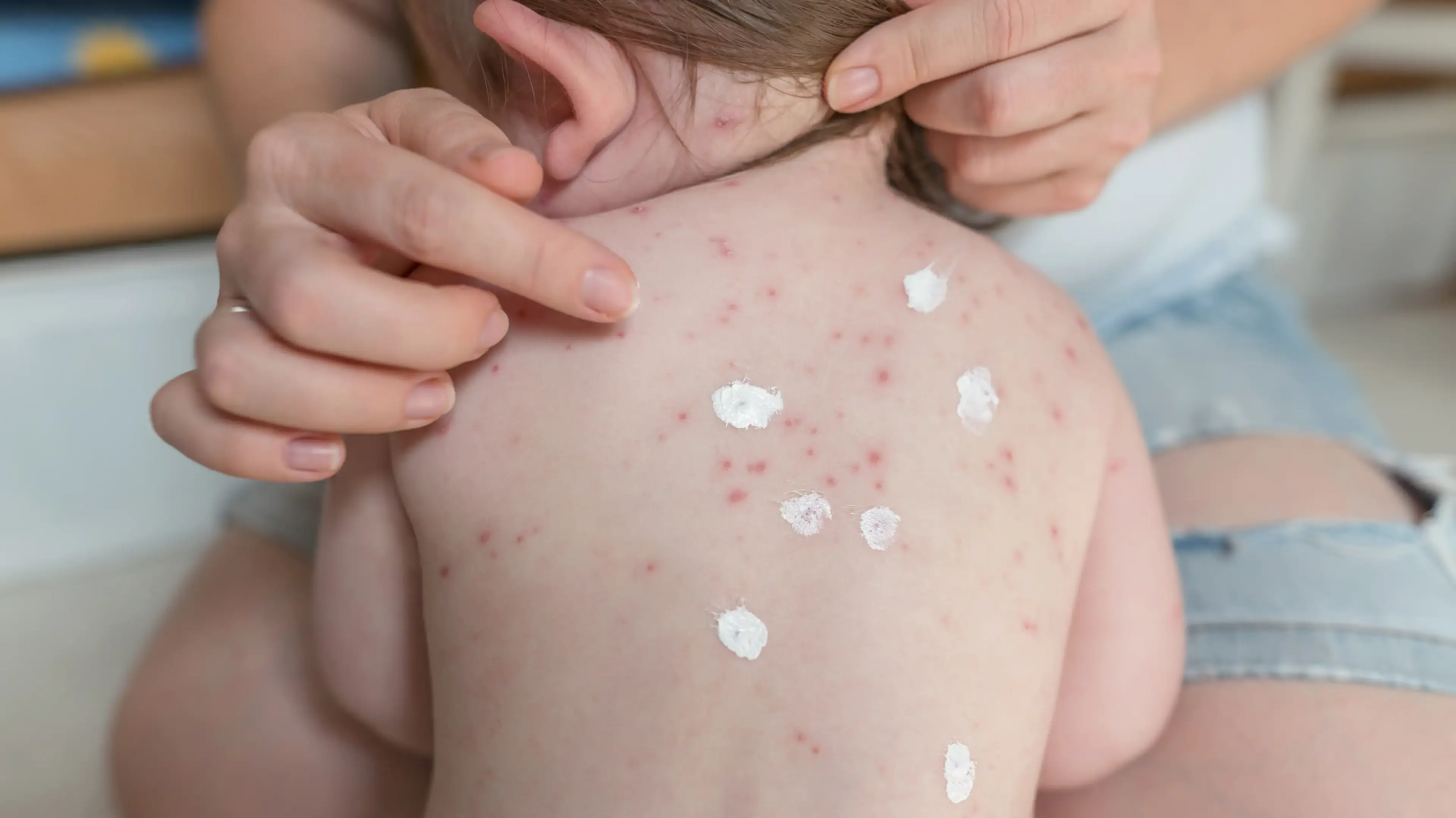 Child's skin rash being treated with topical lotion